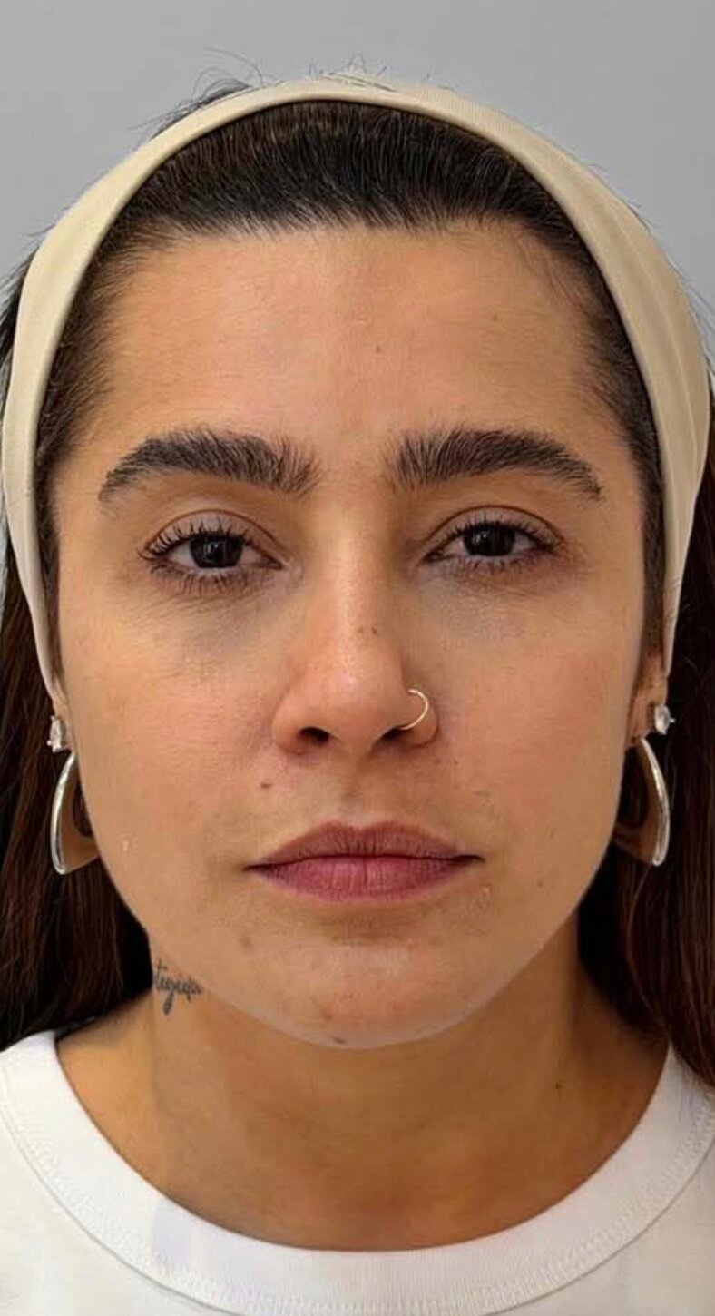 Resultado antes e depois 1